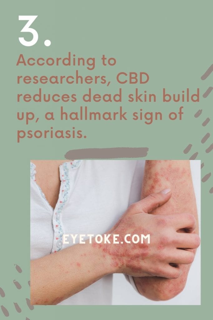 CBD helps with psoriasis.
